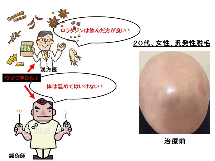 円形脱毛症　病院